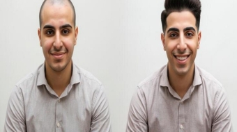 Hair Bonding in Kolkata - Hair Bonding in Howrah - Alisa Enterprise